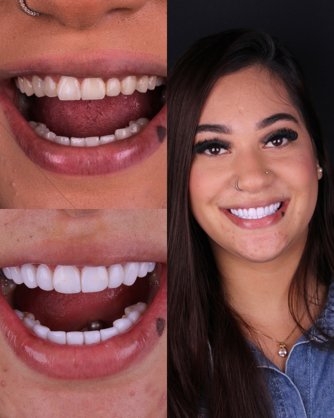 El Arte de las Carillas Dentales