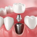 Prótesis dentales: la sonrisa que creías perdida, de vuelta