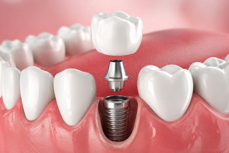 Prótesis dentales: la sonrisa que creías perdida, de vuelta