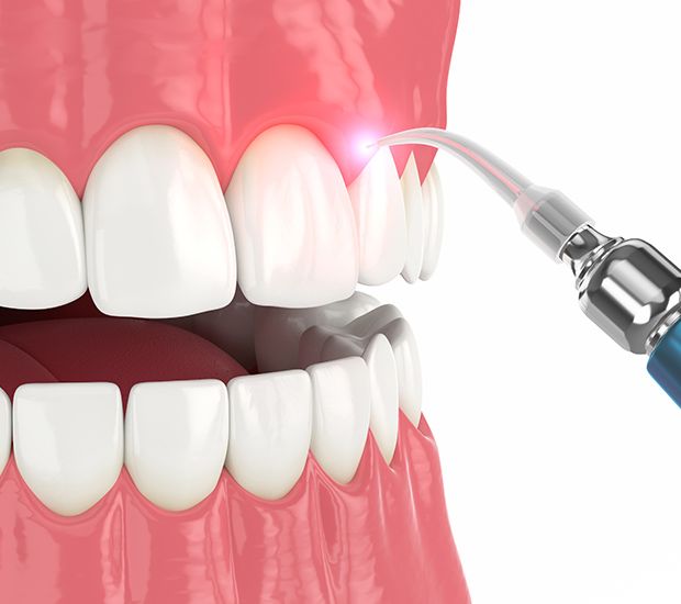 Profilaxis dental